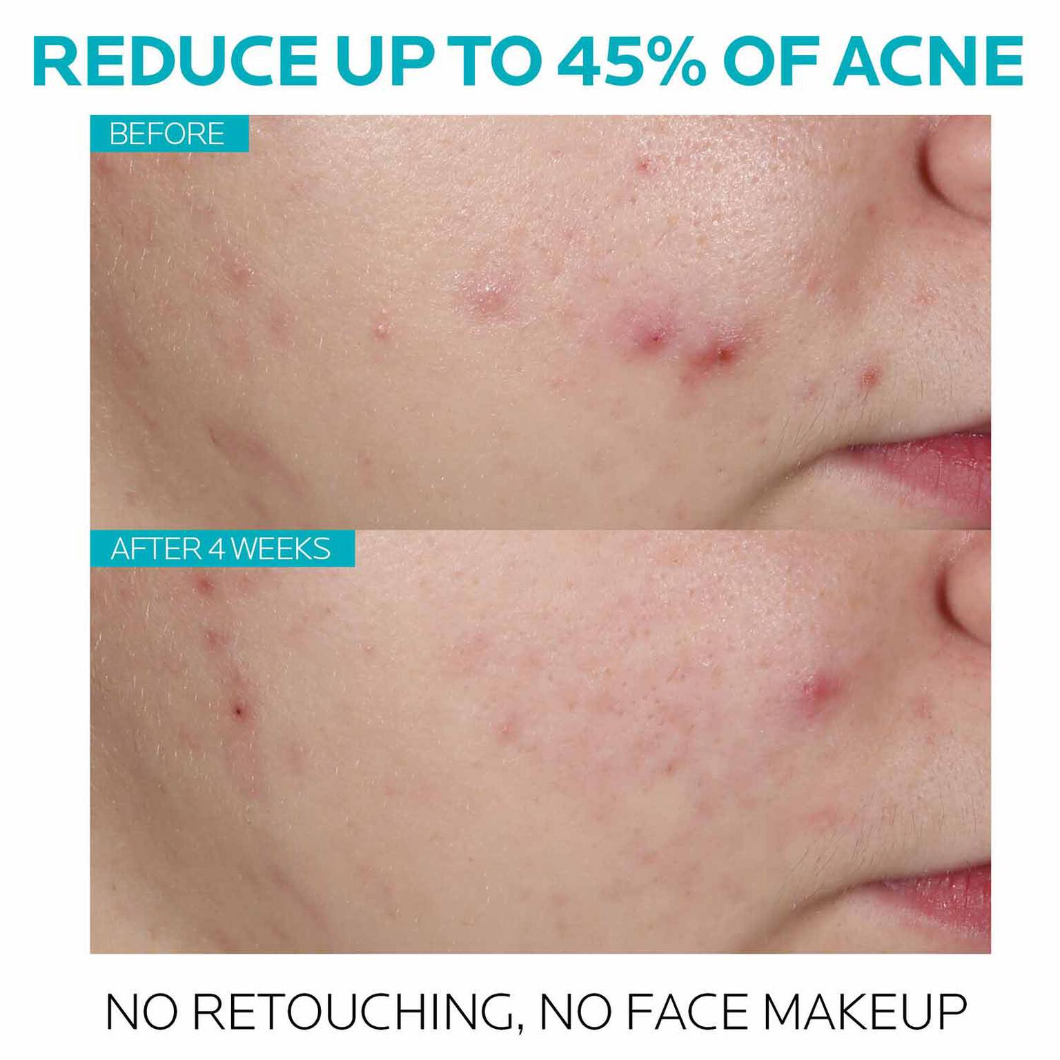 effaclar-salicylic-acid-acne-treatment-serum-f0 7_EffaclarSerum_After-45-days.jpg