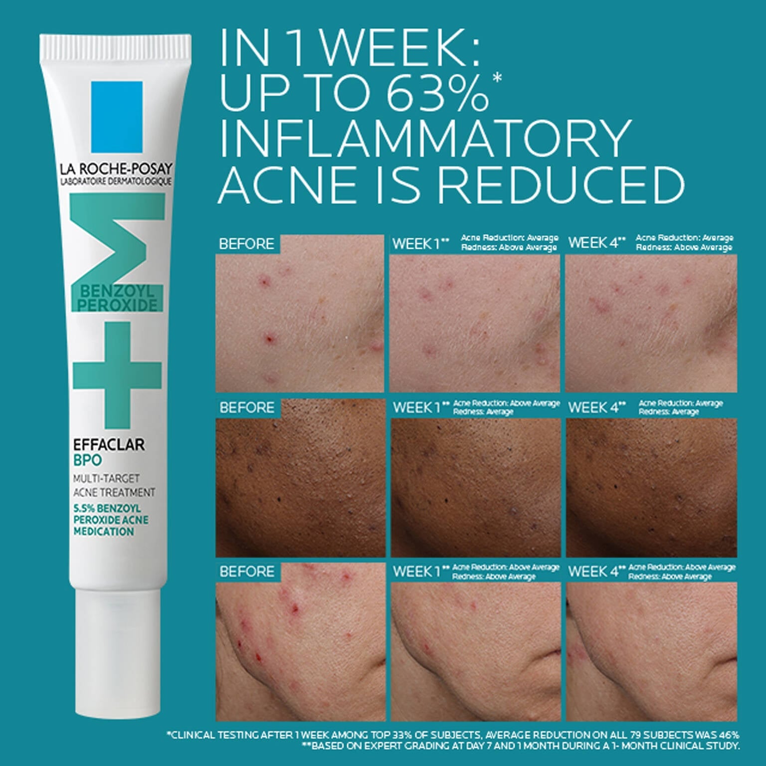 effaclar-bpo-multi-target-acne-treatment-with-5-5-benzoyl-peroxide-g3 EffaclarBPO-ClinicalBA-ATF-1500x1500-2.jpg