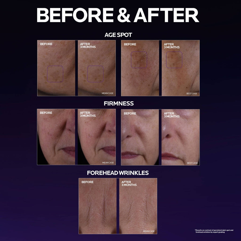 mela-b3-double-dose-discoloration-treatment-with-melasyltm-m2 MelaB3_DD_BTF_BeforeAfter_1500x1500_5.jpg