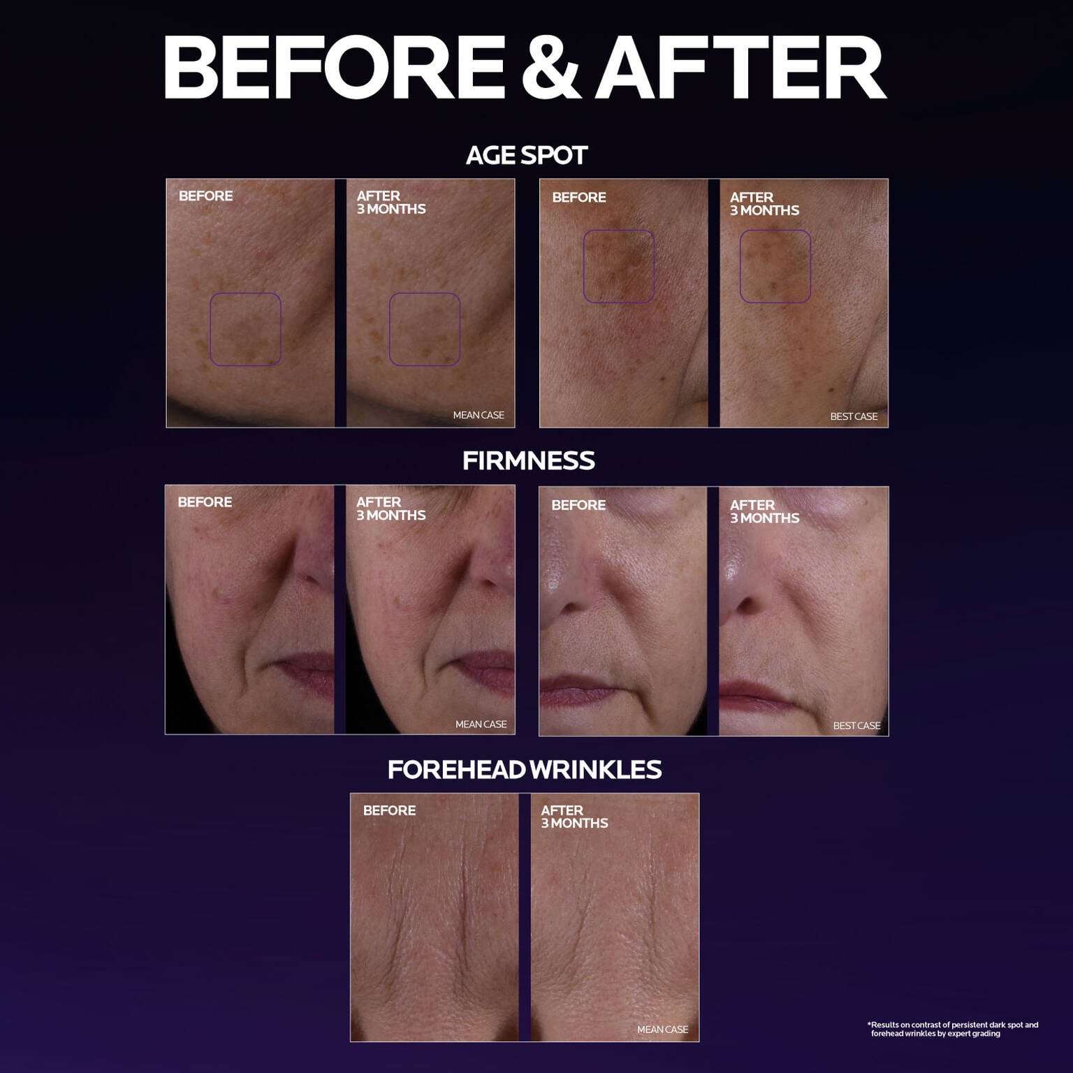 mela-b3-double-dose-discoloration-treatment-with-melasyltm-m2 MelaB3_DD_BTF_BeforeAfter_1500x1500_5.jpg